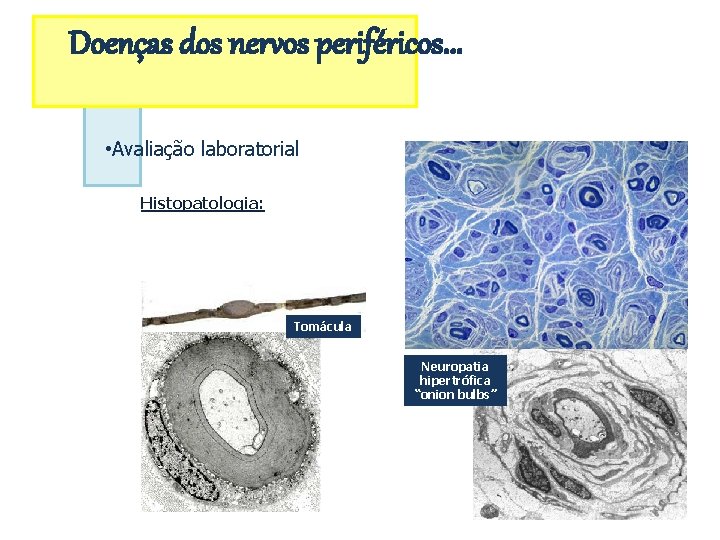 Doenças dos nervos periféricos. . . • Avaliação laboratorial Histopatologia: Tomácula Neuropatia hipertrófica “onion