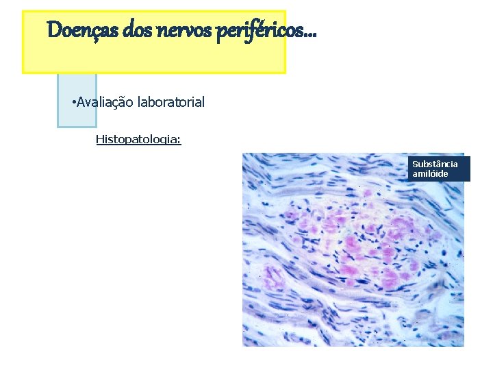 Doenças dos nervos periféricos. . . • Avaliação laboratorial Histopatologia: Substância amilóide 