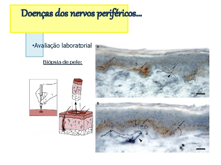 Doenças dos nervos periféricos. . . • Avaliação laboratorial Biópsia de pele: 
