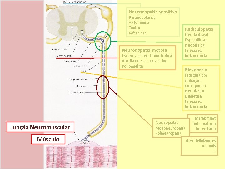 Neuronopatia sensitiva Paraneoplásica Autoimune Tóxica infecciosa Neuronopatia motora Esclerose lateral amiotrófica Atrofia muscular espinhal