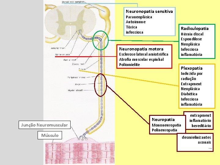 Neuronopatia sensitiva Paraneoplásica Autoimune Tóxica infecciosa Neuronopatia motora Esclerose lateral amiotrófica Atrofia muscular espinhal