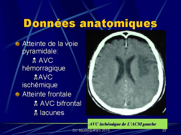Données anatomiques Atteinte de la voie pyramidale: AVC hémorragique AVC ischémique Atteinte frontale AVC