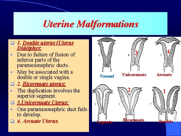 Uterine Malformations q § § q § q 1. Double uterus (Uterus Didelphys: Due