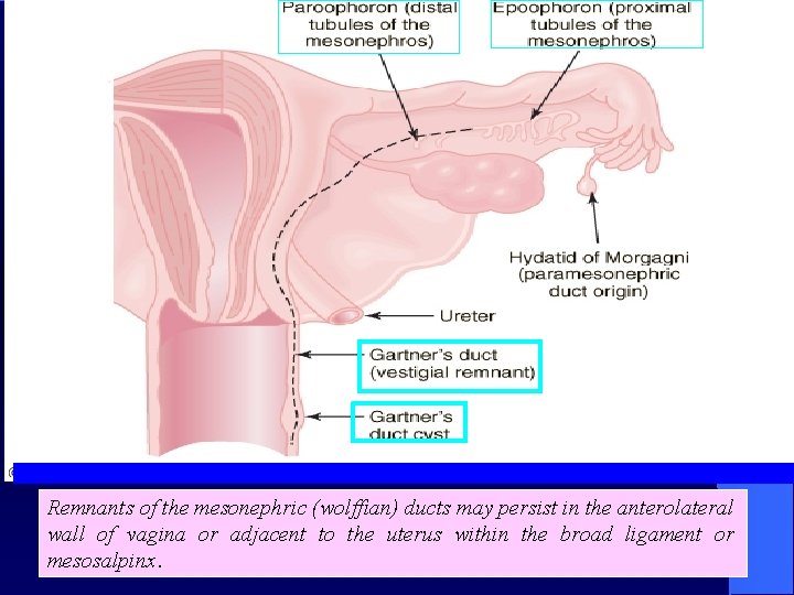 Remnants of the mesonephric (wolffian) ducts may persist in the anterolateral wall of vagina