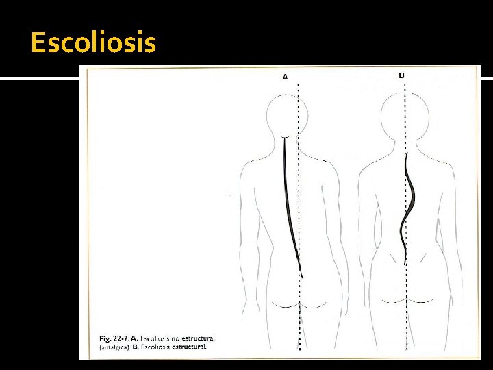 Escoliosis Escoliosis