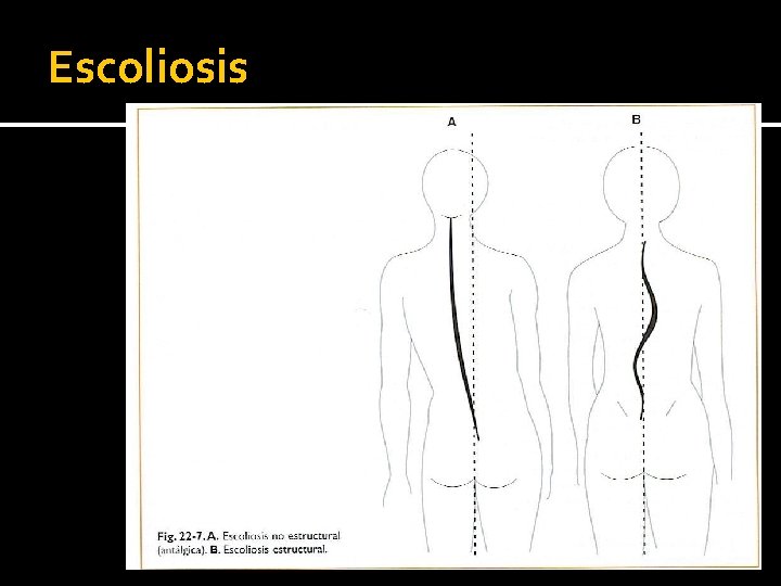 Escoliosis 