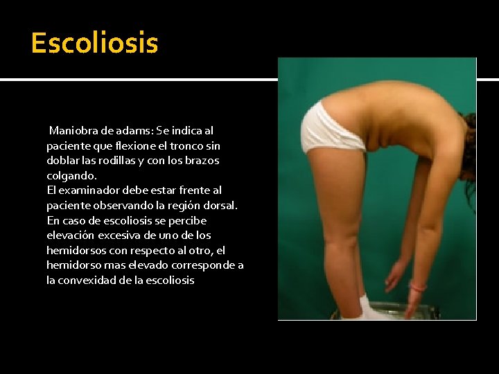 Escoliosis Maniobra de adams: Se indica al paciente que flexione el tronco sin doblar