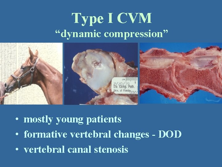 Type I CVM “dynamic compression” • mostly young patients • formative vertebral changes -