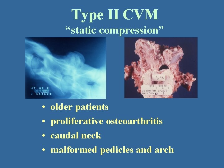 Type II CVM “static compression” • • older patients proliferative osteoarthritis caudal neck malformed