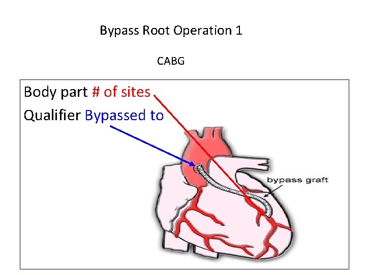 Bypass Root Operation 1 CABG Body part # of sites Qualifier Bypassed to 