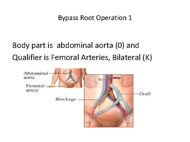 Bypass Root Operation 1 Body part is abdominal aorta (0) and Qualifier is Femoral