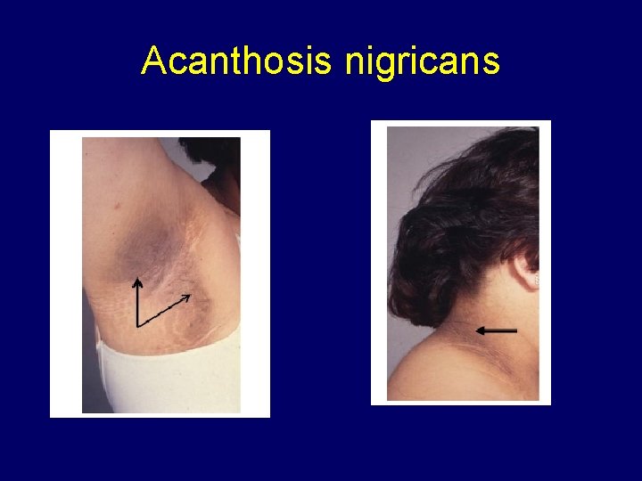 Acanthosis nigricans 