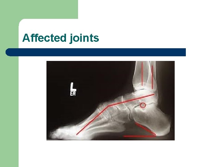 Affected joints 