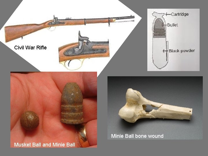 Civil War Rifle Minie Ball bone wound Musket Ball and Minie Ball 