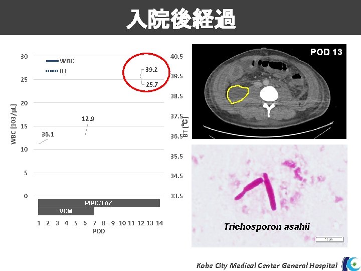 入院後経過 30 WBC BT 39. 2 25. 7 38. 5 20 15 39. 5