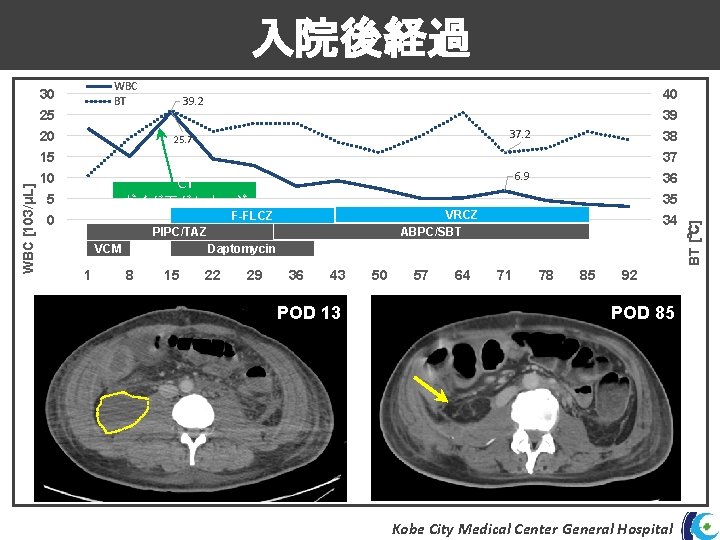入院後経過 WBC BT 30 25 20 40 39. 2 39 37. 2 25. 7