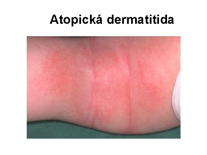 Atopická dermatitida 