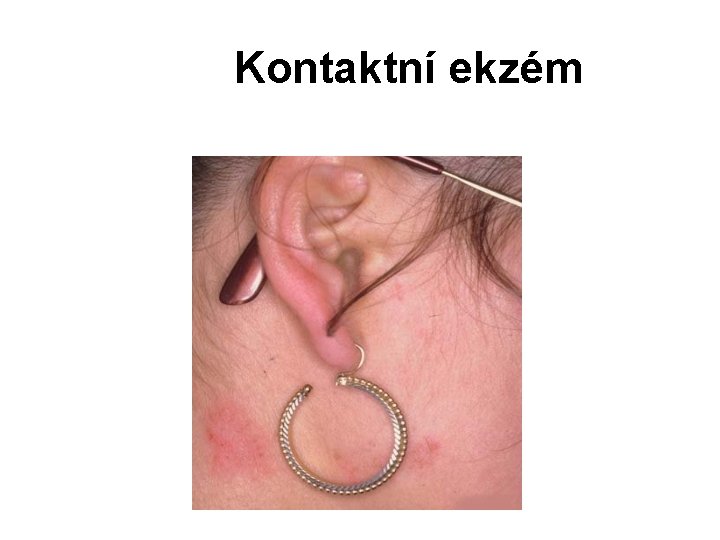 Kontaktní ekzém 