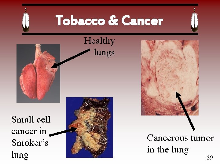 Tobacco & Cancer Healthy lungs Small cell cancer in Smoker’s lung Cancerous tumor in