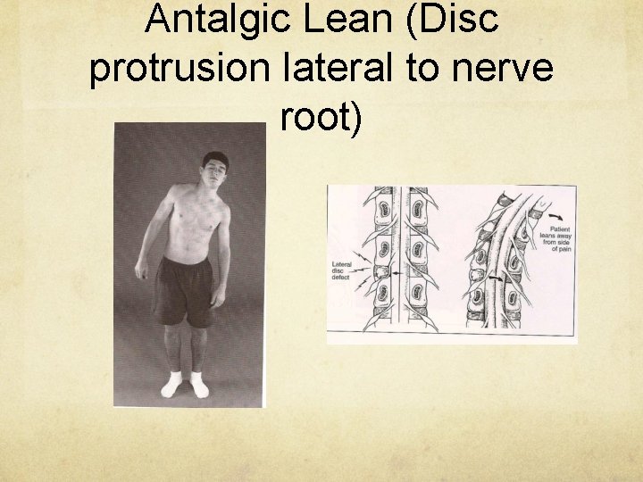 Antalgic Lean (Disc protrusion lateral to nerve root) 