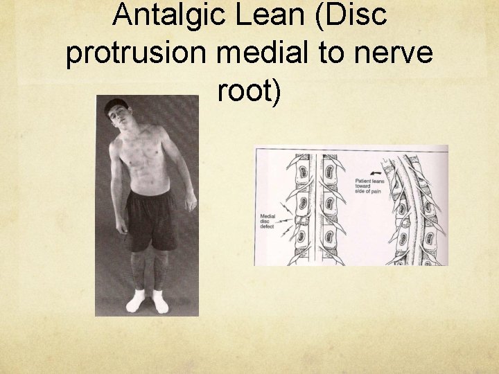 Antalgic Lean (Disc protrusion medial to nerve root) 