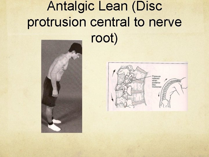 Antalgic Lean (Disc protrusion central to nerve root) 