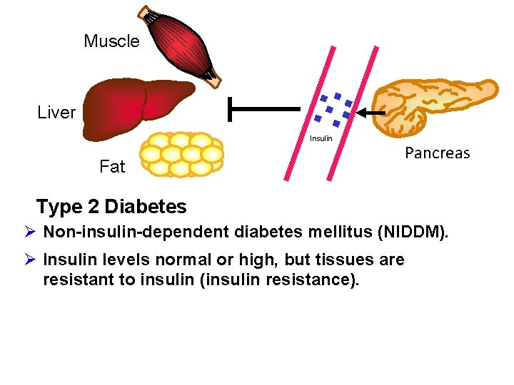 Muscle Liver Insulin Fat Pancreas Type 2 Diabetes Ø Non-insulin-dependent diabetes mellitus (NIDDM). Ø
