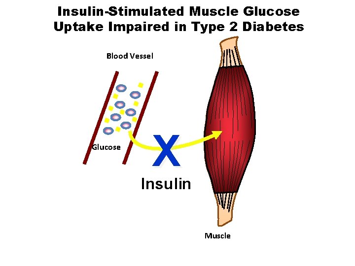 Insulin-Stimulated Muscle Glucose Uptake Impaired in Type 2 Diabetes Blood Vessel Glucose X Insulin