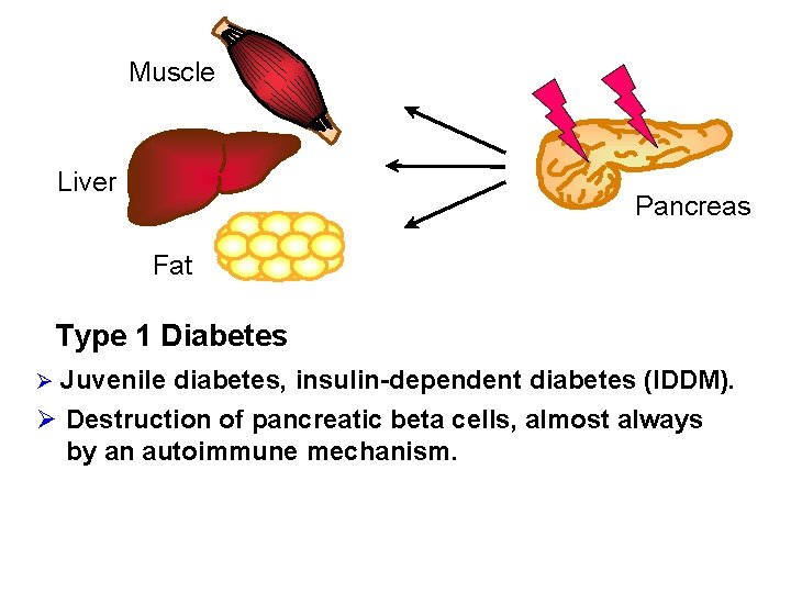 Muscle Liver Pancreas Fat Type 1 Diabetes Ø Juvenile diabetes, insulin-dependent diabetes (IDDM). Ø