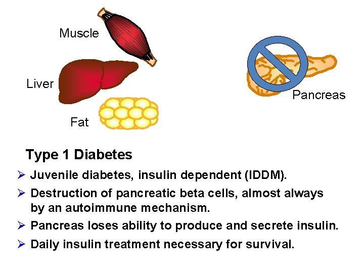 Muscle Liver Pancreas Fat Type 1 Diabetes Ø Juvenile diabetes, insulin dependent (IDDM). Ø