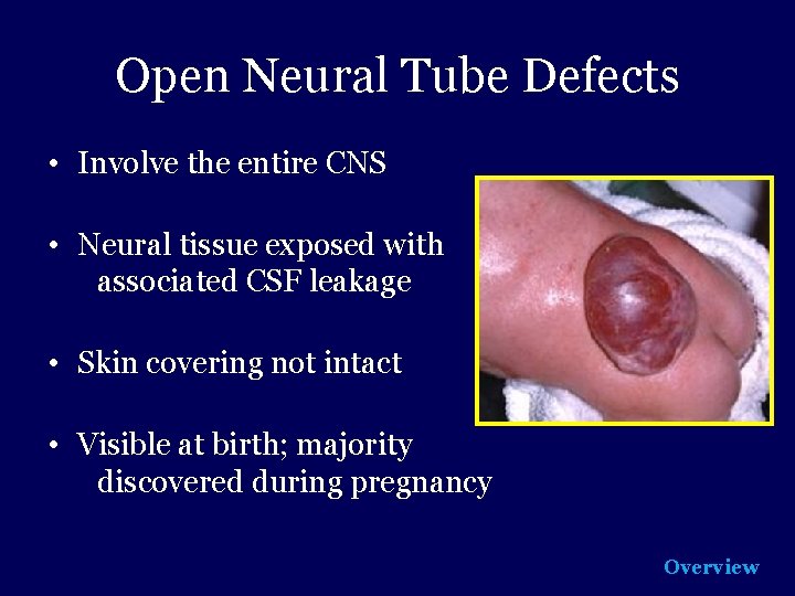 Open Neural Tube Defects • Involve the entire CNS • Neural tissue exposed with