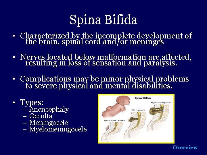 Spina Bifida • Characterized by the incomplete development of the brain, spinal cord and/or
