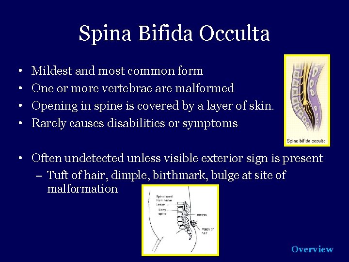 Spina Bifida Occulta • • Mildest and most common form One or more vertebrae