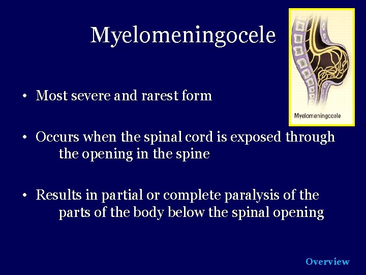 Myelomeningocele • Most severe and rarest form • Occurs when the spinal cord is