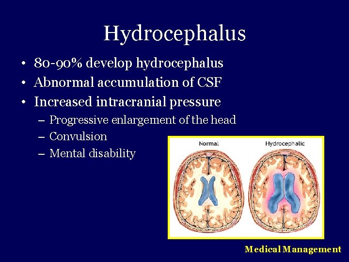 Hydrocephalus • 80 -90% develop hydrocephalus • Abnormal accumulation of CSF • Increased intracranial