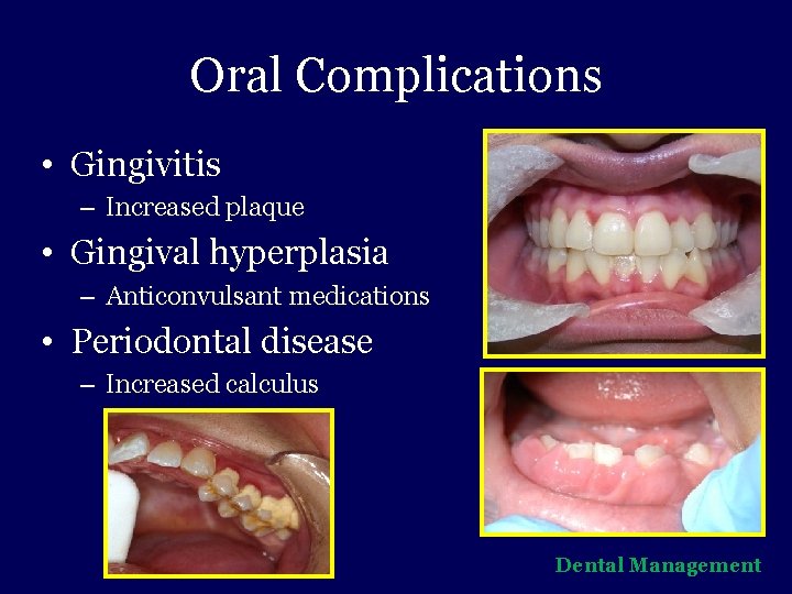 Oral Complications • Gingivitis – Increased plaque • Gingival hyperplasia – Anticonvulsant medications •