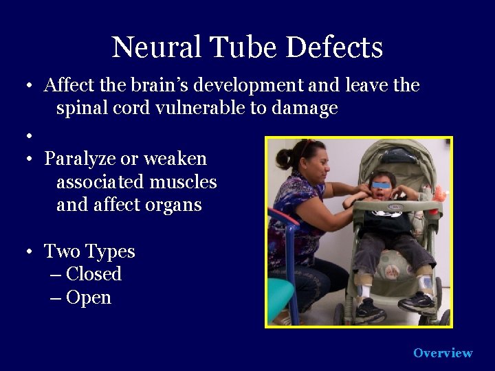 Neural Tube Defects • Affect the brain’s development and leave the spinal cord vulnerable