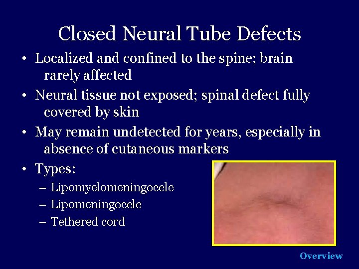 Closed Neural Tube Defects • Localized and confined to the spine; brain rarely affected
