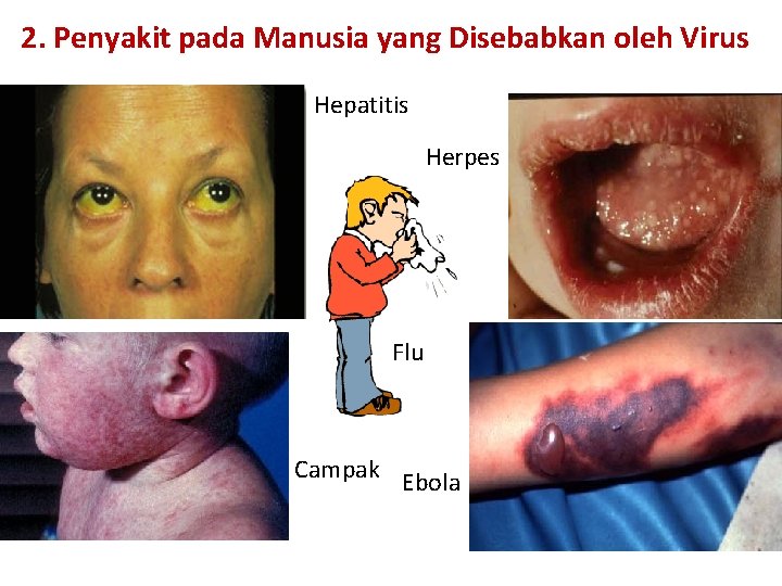2. Penyakit pada Manusia yang Disebabkan oleh Virus Hepatitis Herpes Flu Campak Ebola 