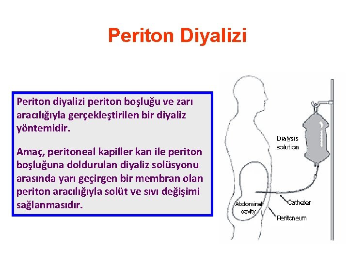 Periton Diyalizi Periton diyalizi periton boşluğu ve zarı aracılığıyla gerçekleştirilen bir diyaliz yöntemidir. Amaç,
