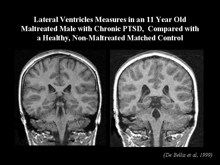 Lateral Ventricles Measures in an 11 Year Old Maltreated Male with Chronic PTSD, Compared