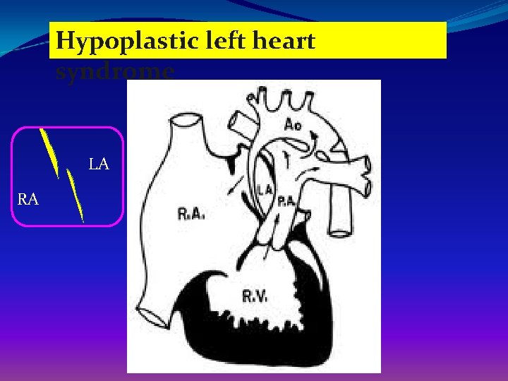Hypoplastic left heart syndrome LA RA 