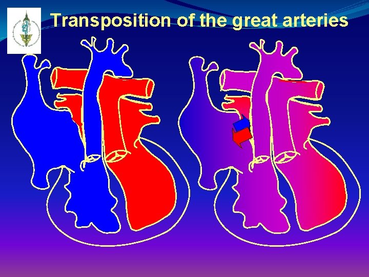 Transposition of the great arteries 