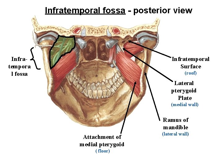 Infratemporal fossa - posterior view Infratempora l fossa Infratemporal Surface (roof) Lateral pterygoid Plate