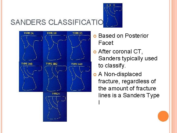 SANDERS CLASSIFICATION Based on Posterior Facet After coronal CT, Sanders typically used to classify.