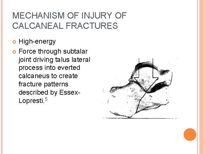 MECHANISM OF INJURY OF CALCANEAL FRACTURES High-energy Force through subtalar joint driving talus lateral