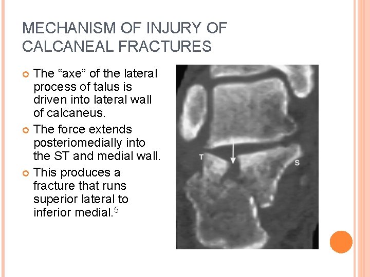 MECHANISM OF INJURY OF CALCANEAL FRACTURES The “axe” of the lateral process of talus