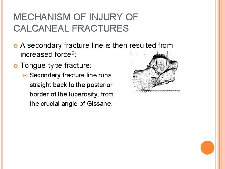 MECHANISM OF INJURY OF CALCANEAL FRACTURES A secondary fracture line is then resulted from