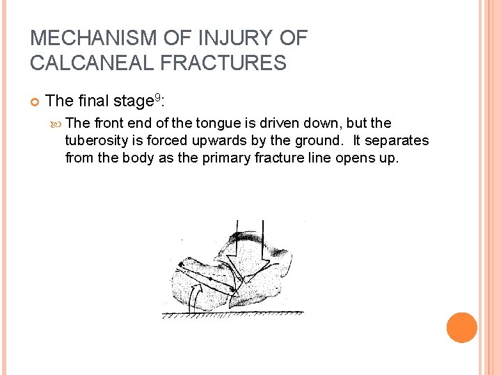 MECHANISM OF INJURY OF CALCANEAL FRACTURES The final stage 9: The front end of