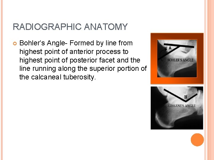 RADIOGRAPHIC ANATOMY Bohler’s Angle- Formed by line from highest point of anterior process to